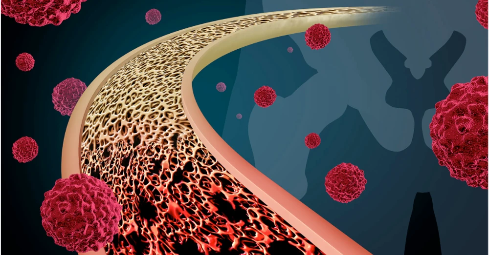 Bone Cancer