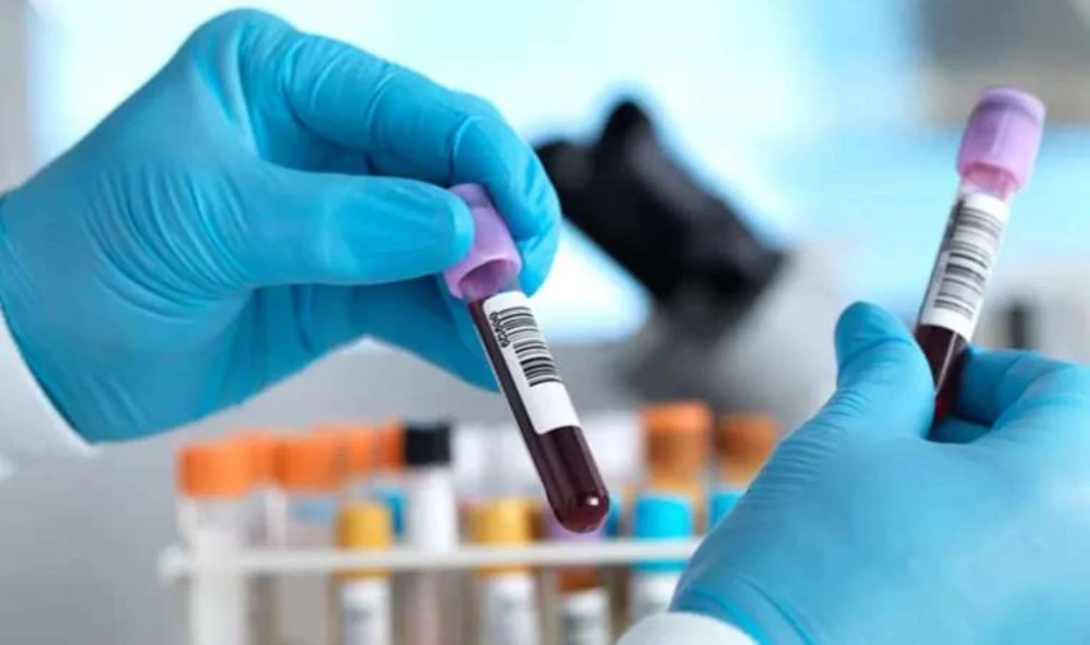 MPV in Blood Test