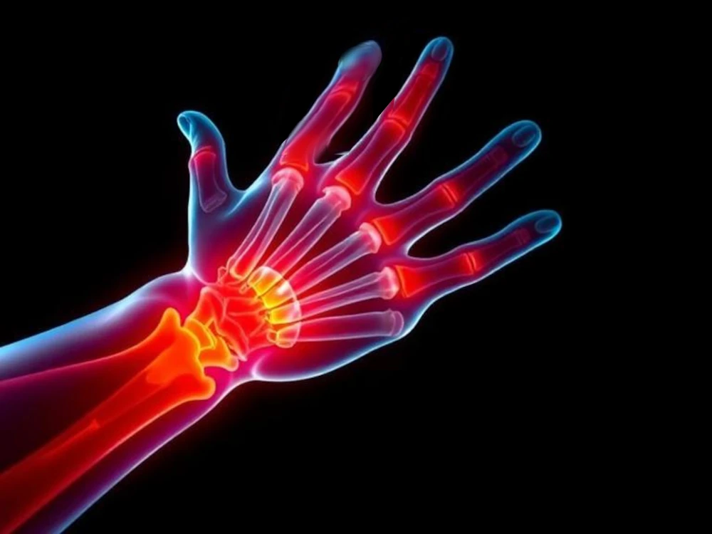 What is Carpal Tunnel Syndrome